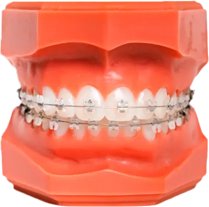 Close-up of clear braces on teeth during orthodontic treatment at Moroco Orthodontics Delray Beach
