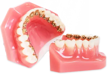 Close-up of Incognito lingual braces on inner teeth surface, Moroco Orthodontics Delray Beach